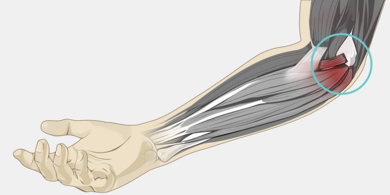 epitrocleite tratamento