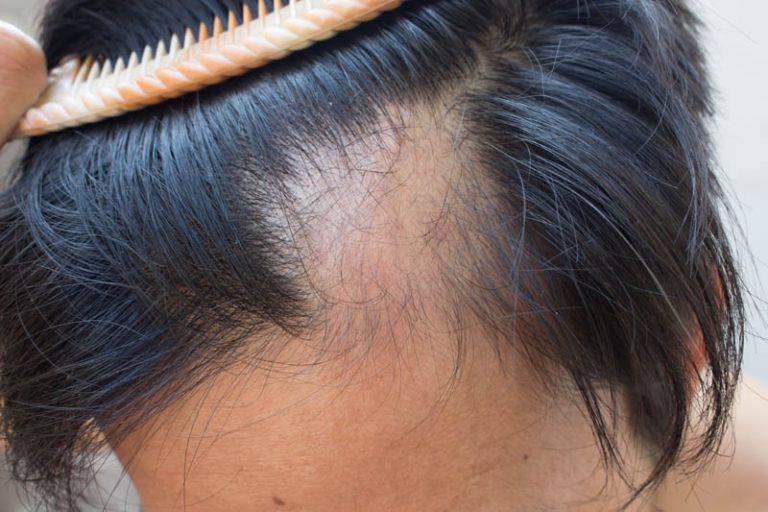 tratamento alopecia porto