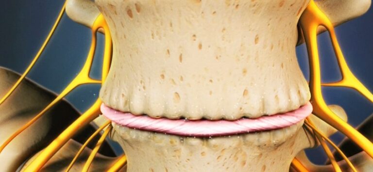 degeneração coluna