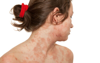 Eczema Atópico (Dermatite Atópica): Como Tratar com a Medicina Chinesa